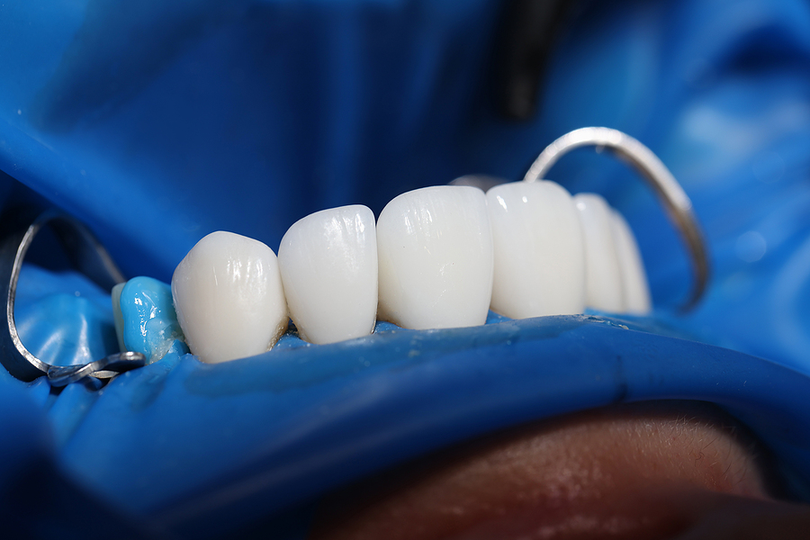 Installation Of Veneers And Dental Implants In Clinic Closeup. D