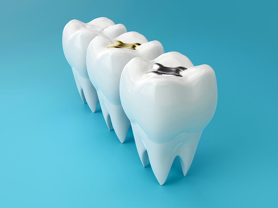 Teeth With Gold, Amalgam And Composite Inlay Dental Filling, Per